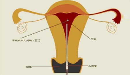 十堰招聘捐卵女孩